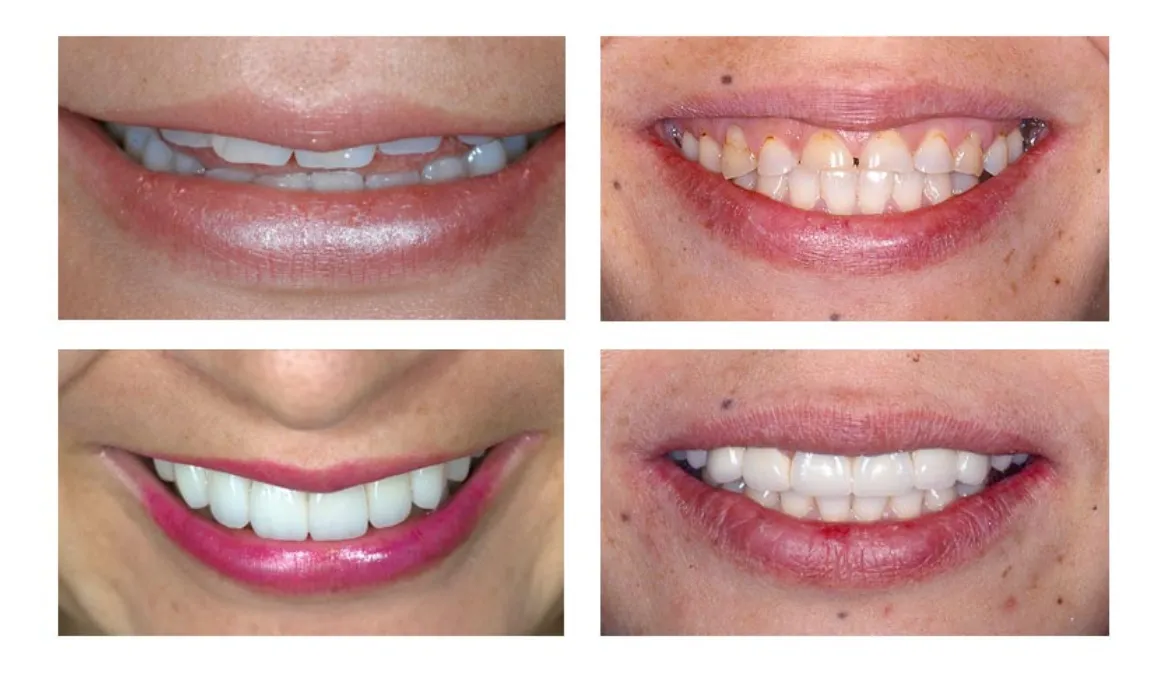 Smile Makeover Magic with Full Mouth Rehabilitation