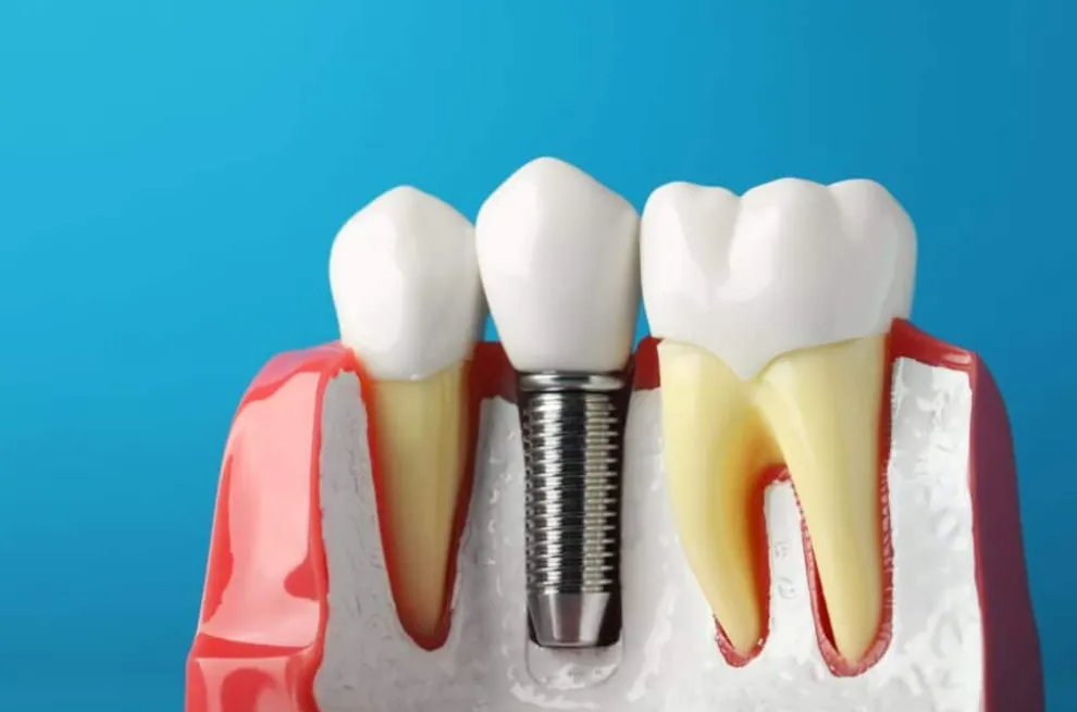 The Financial and Functional Value of Investing in Dental Implants